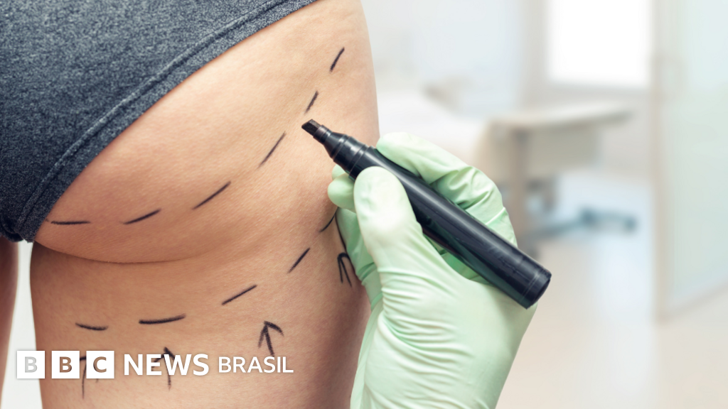 Brazilian Butt Lift: O Procedimento Estético que está sob Fogo no Reino Unido!
