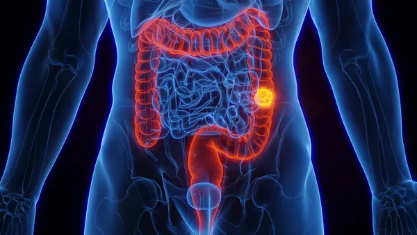 Câncer de Intestino: SUS Adota Novo Exame para Detecção Precoce
