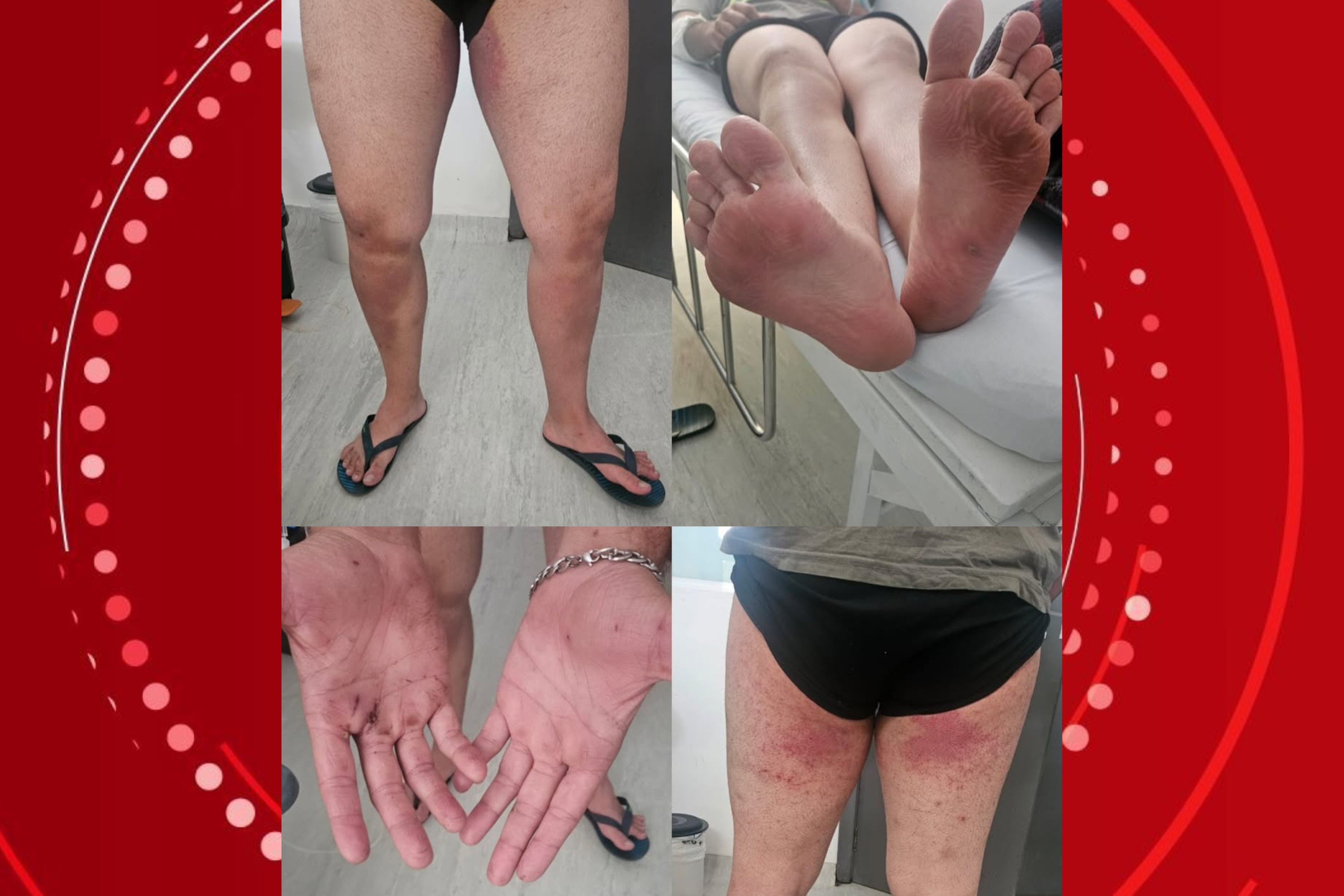 Irmã divulga imagens das lesões de jovem que se perdeu em trilha no Pico Paraná