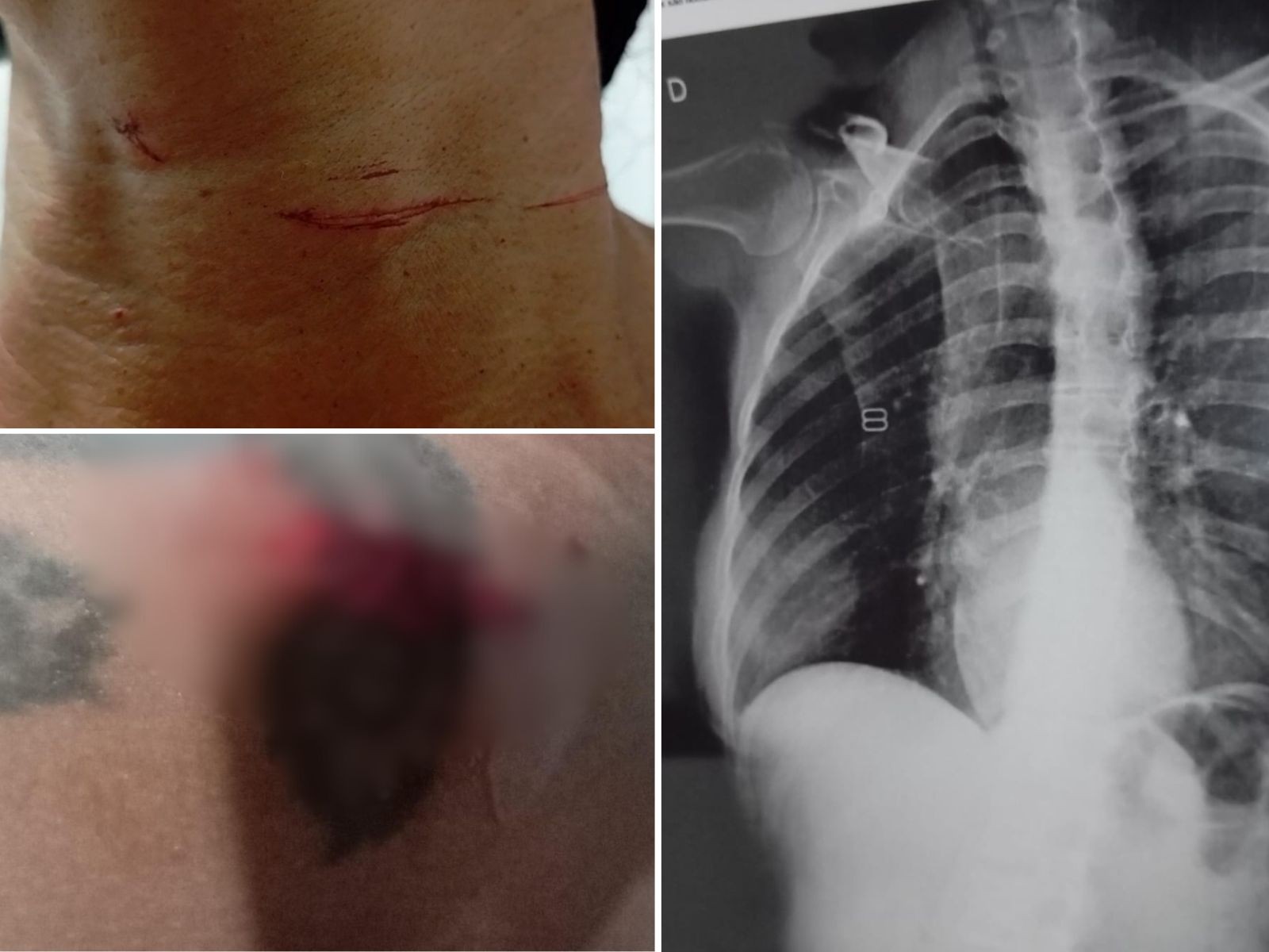 Mulher se joga da moto após ser atingida por linha com cerol e fratura costelas: 'Teria mo