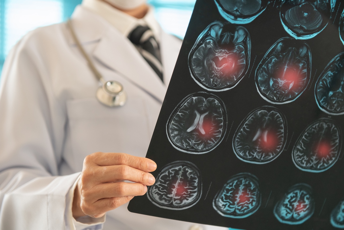 Neurologista explica o que é um AVC e quais são os principais sintomas