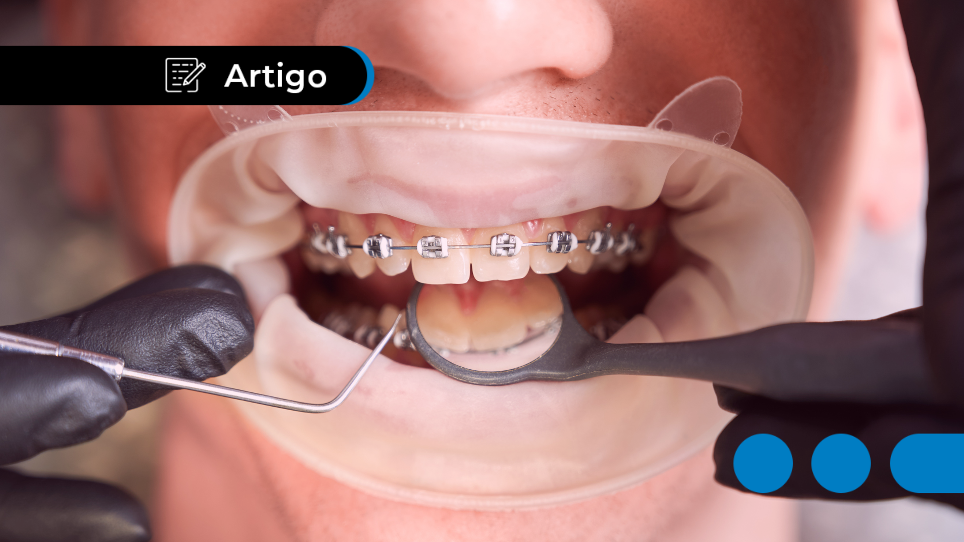 Quanto Custa Colocar Aparelho Ortodôntico: Cuidado com os Preços!