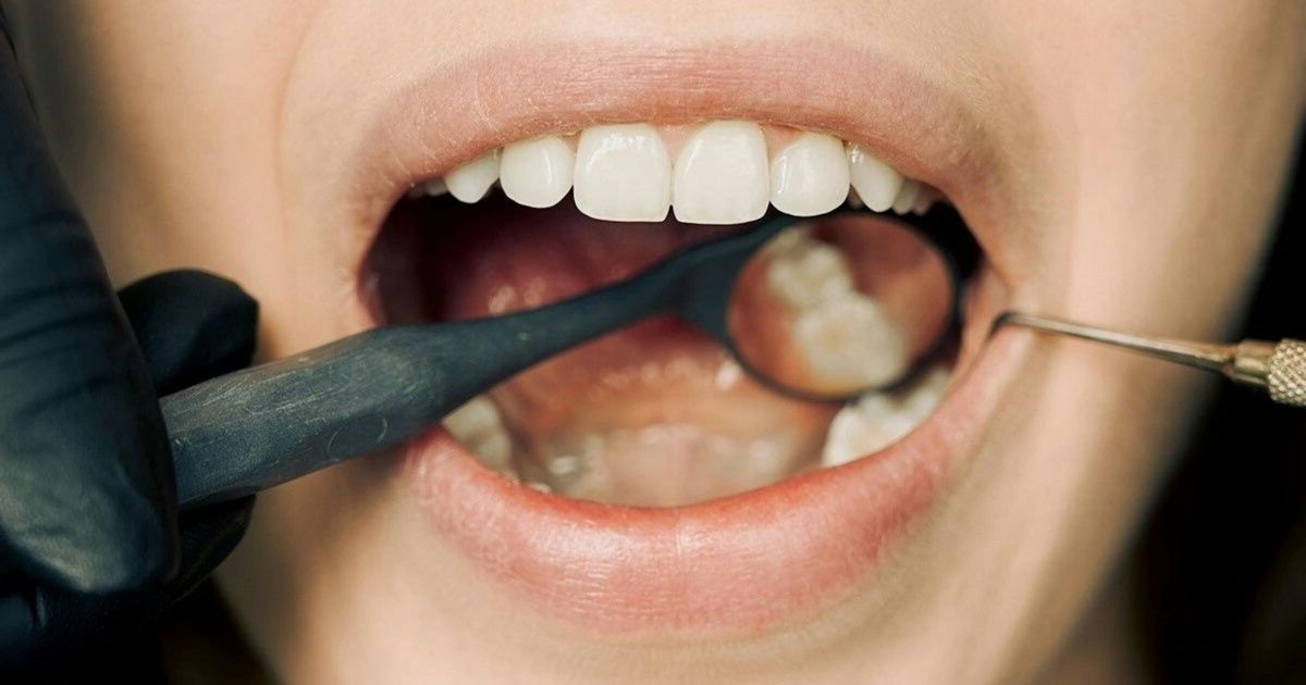 Uso regular de fio dental pode reduzir risco de avc, aponta estudo
