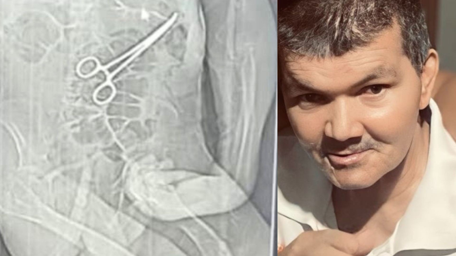 Vereadores instauram CPI para apurar morte de idoso que ficou com pinça dentro do corpo ap